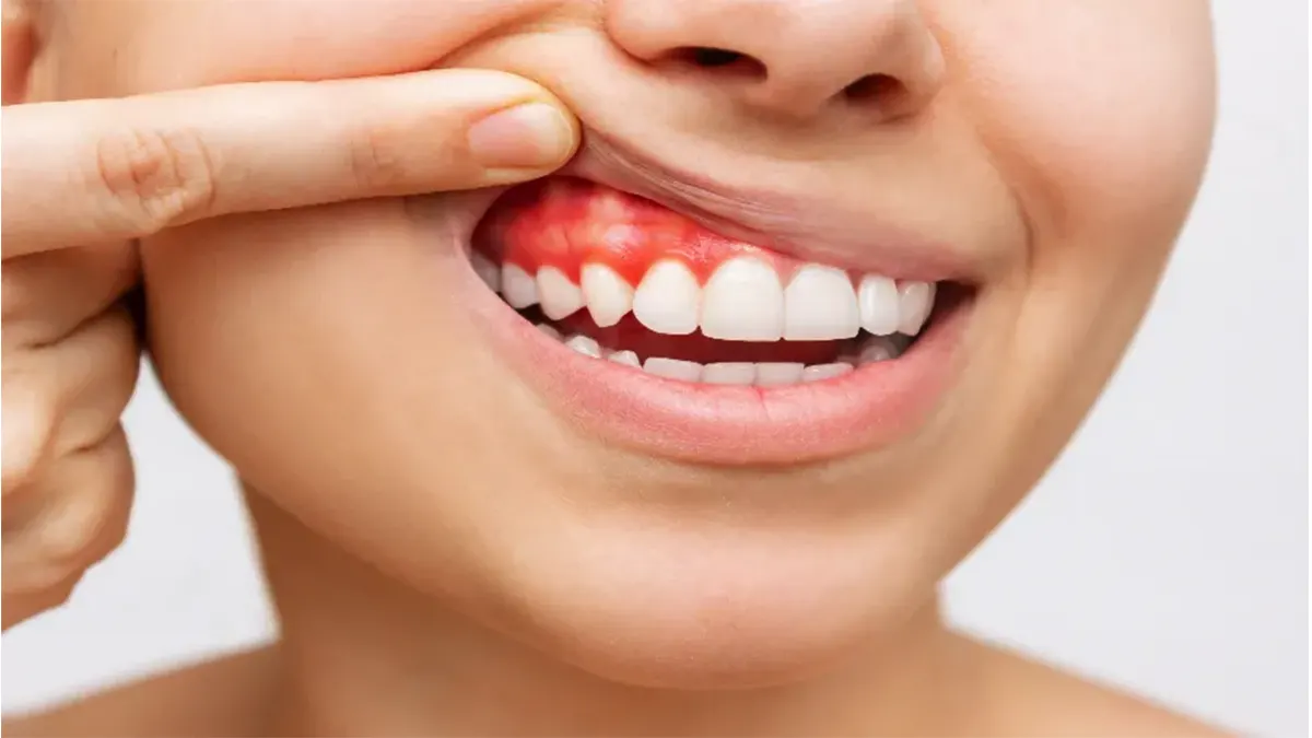 Diş Eti Hastalıkları (Periodontoloji)